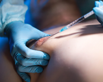 Gynecomastia Surgery